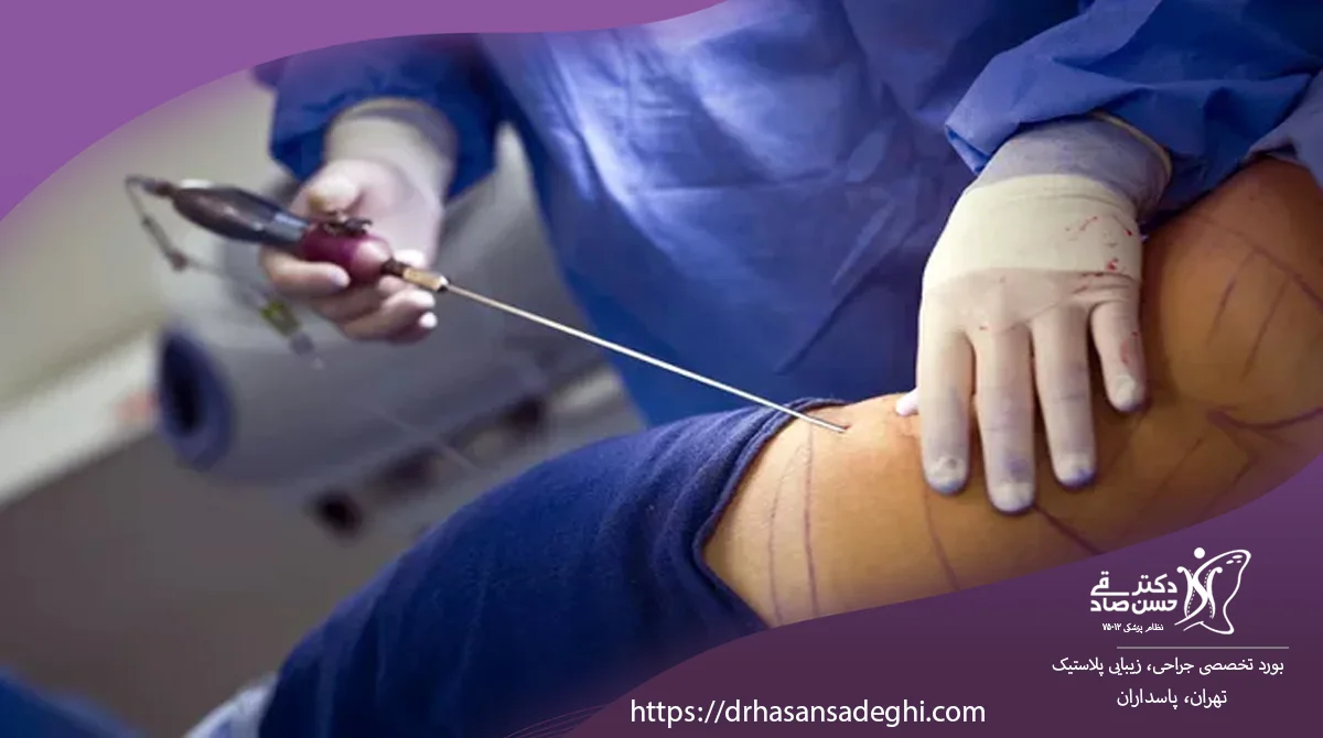 How Long Do Liposuction Results Last